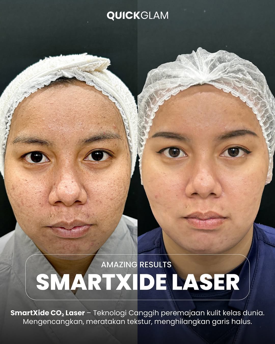 Dari-kulit-bertekstur-jadi-halus-glowing-✨Bekas-jerawat-scar-pori-pori-besar-dan-garis-halu.jpg