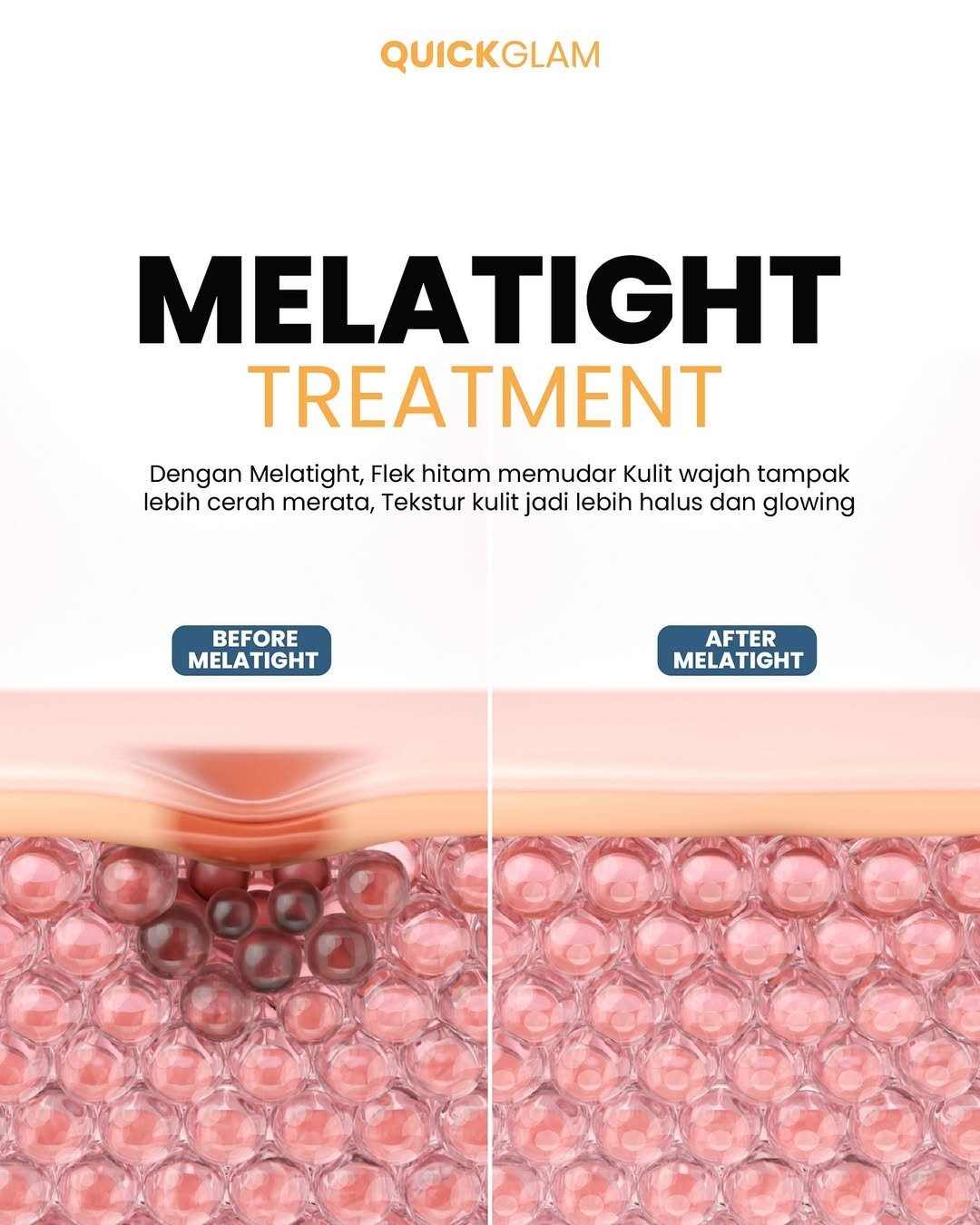 Flek-hitam-melasma-Tenang-ada-solusinyaMelatight-Treatment-dari-Quickglam-bantu-memudarkan-n.jpg