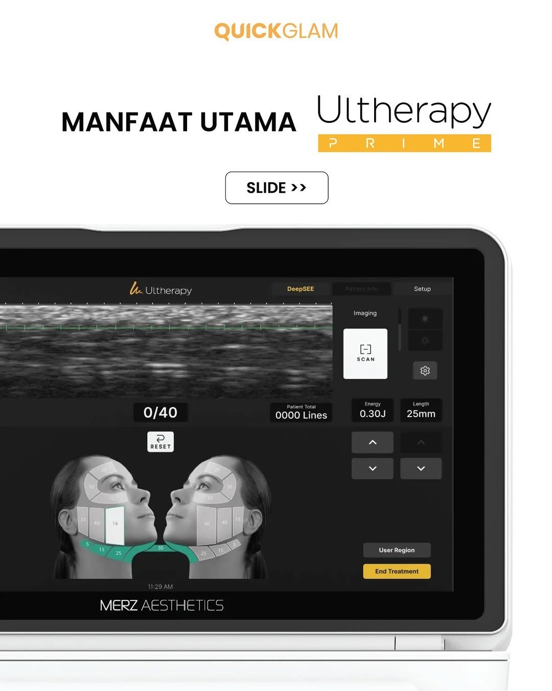 Ultherapy-Prime-treatment-yang-sangat-direkomendasikan-usia-30–50anyang-mulai-merasa-kulit-menur.jpg
