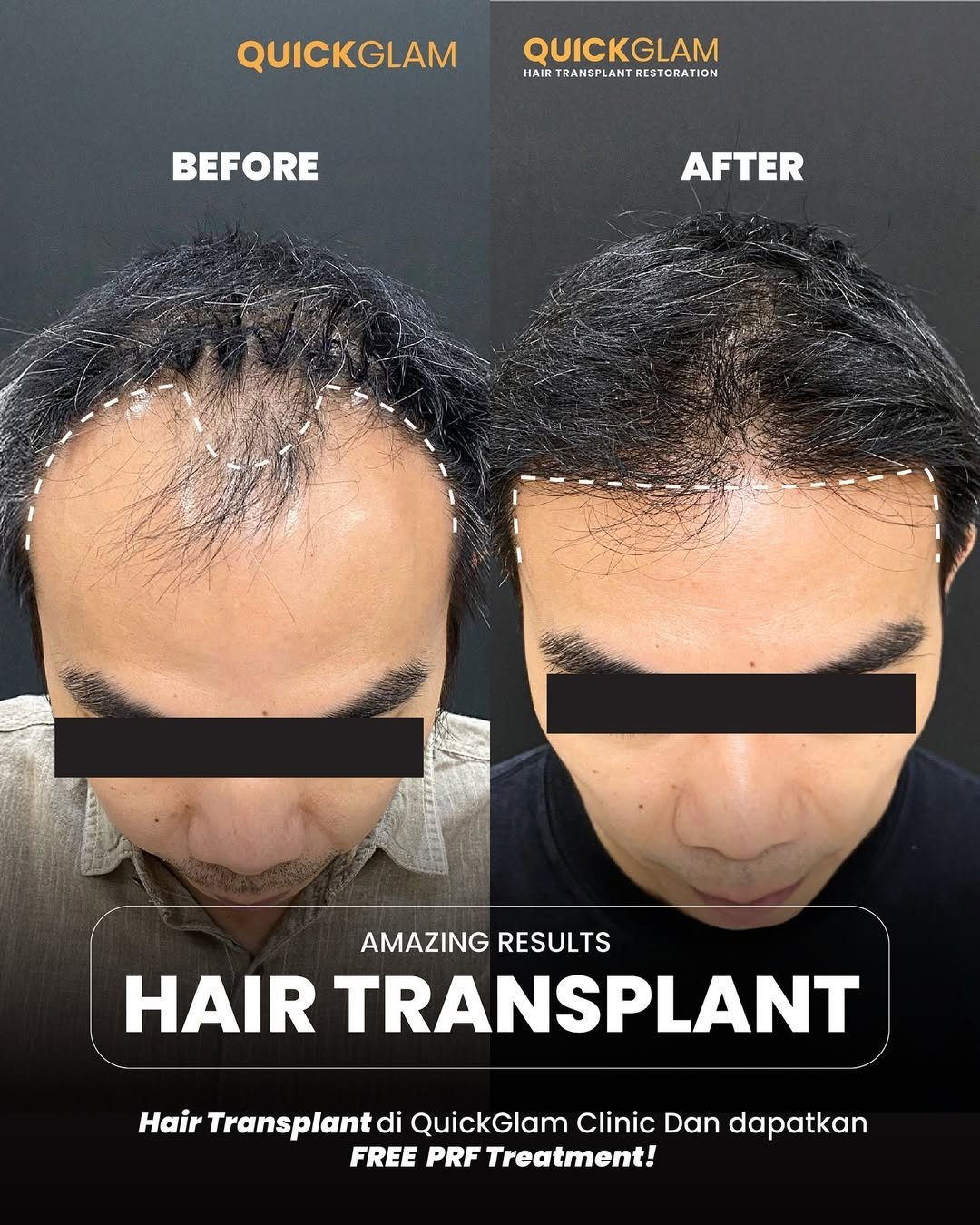 ❌-Rambut-tipis-hairline-mundur-bikin-nggak-pede✅-Saatnya-balikin-rambut-dan-rasa-percaya-diri-.jpg