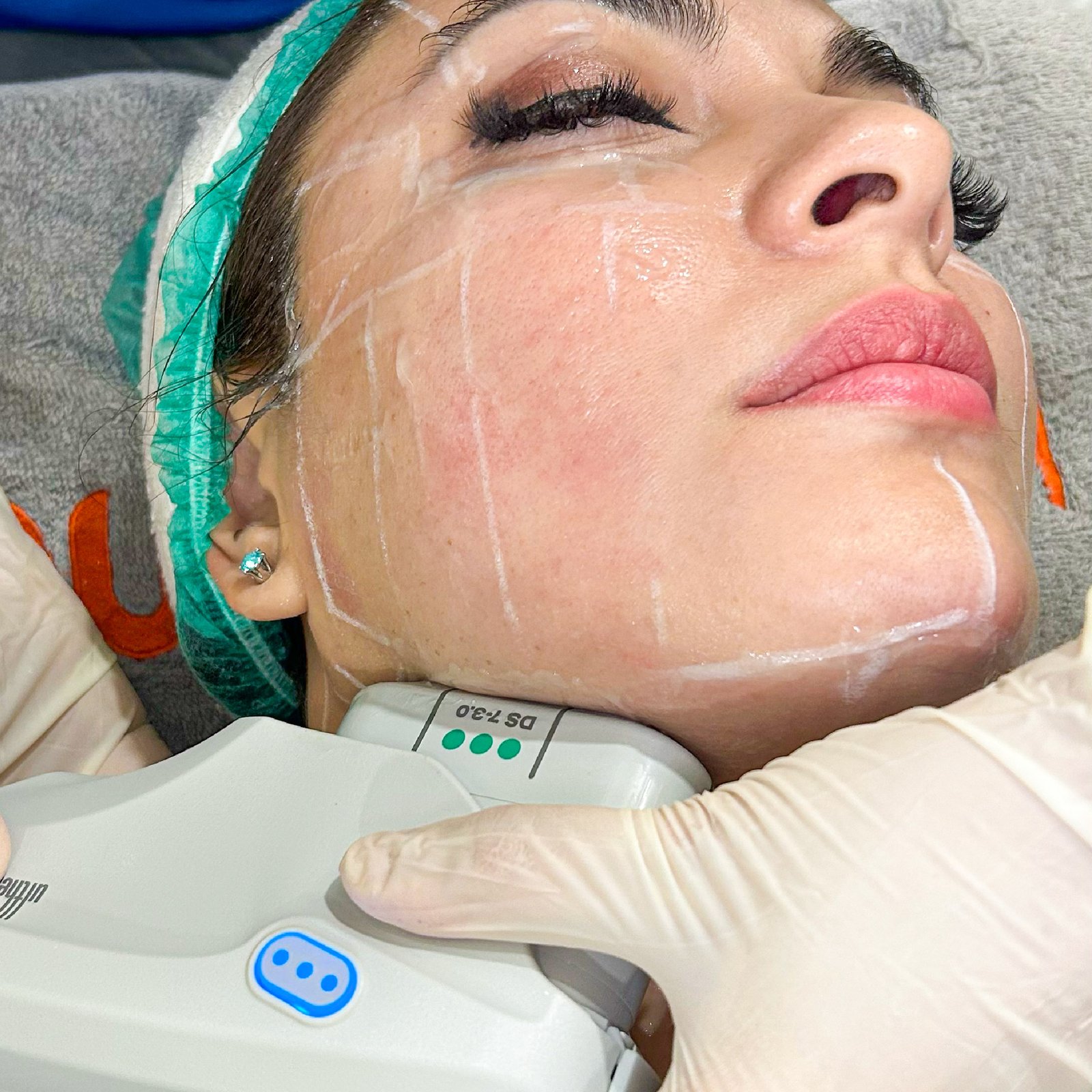 aset fikri ultherapy-06.jpg