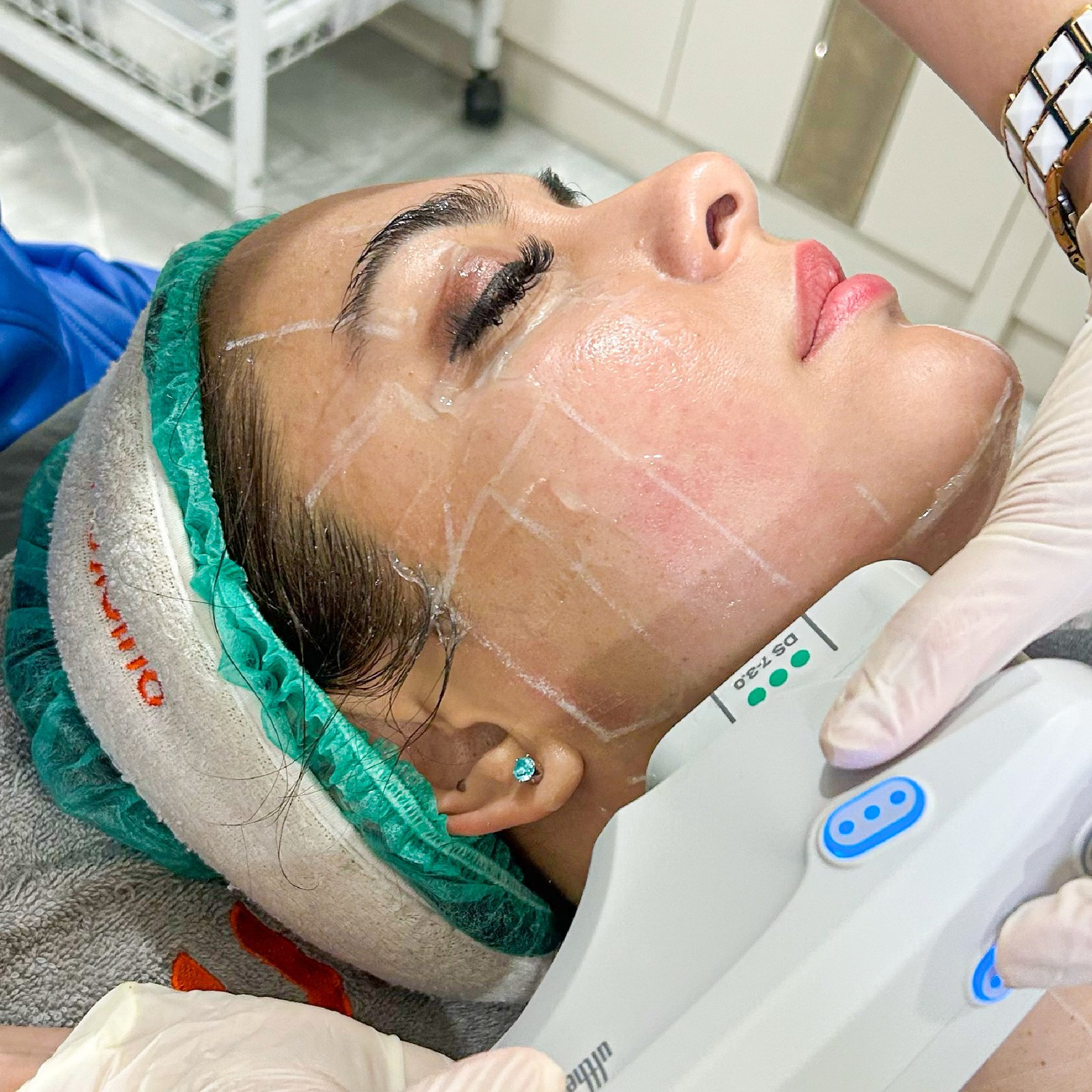 aset fikri ultherapy-07.jpg