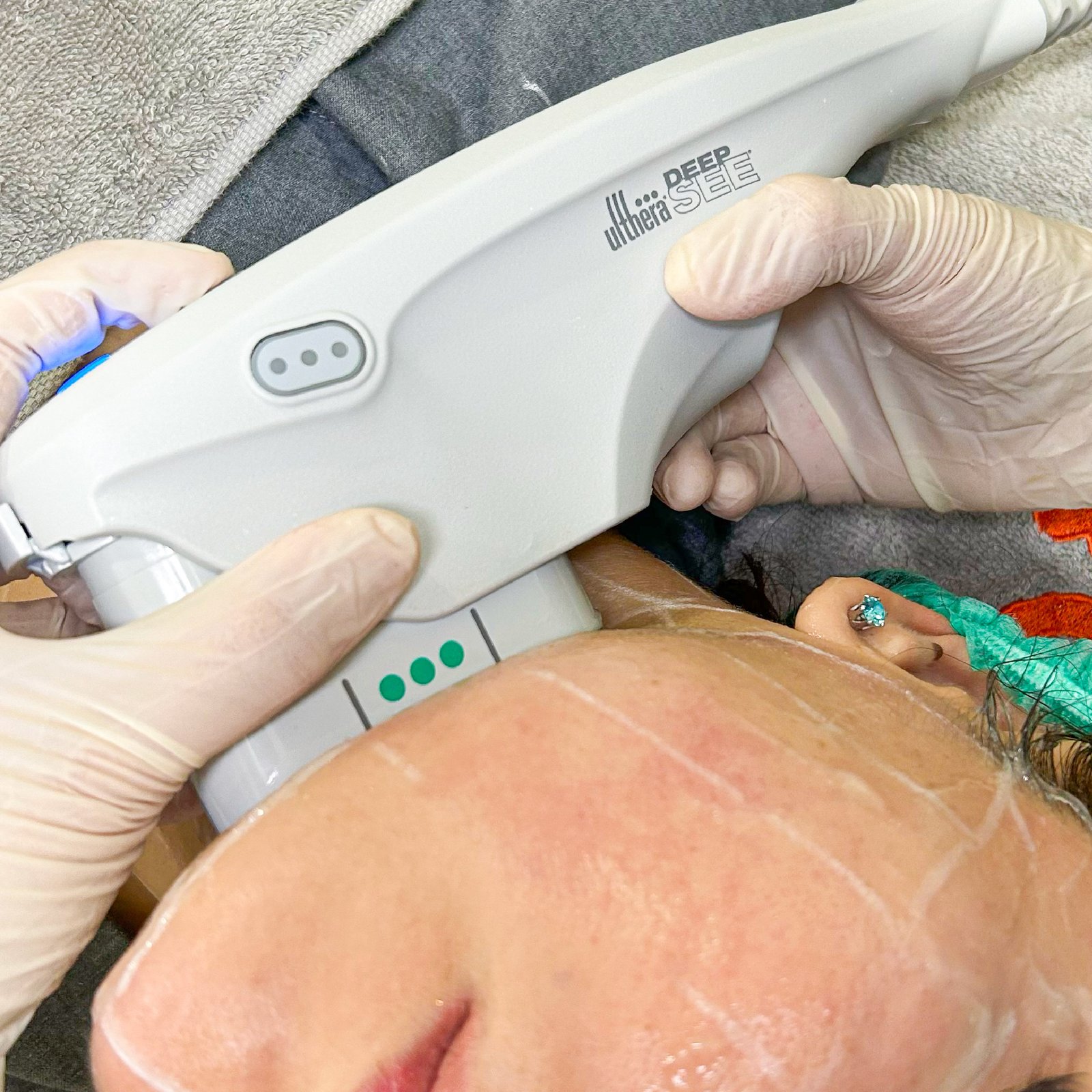 aset fikri ultherapy-08.jpg