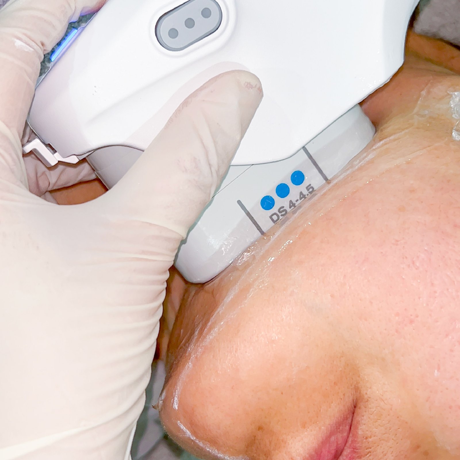 aset fikri ultherapy-10.jpg