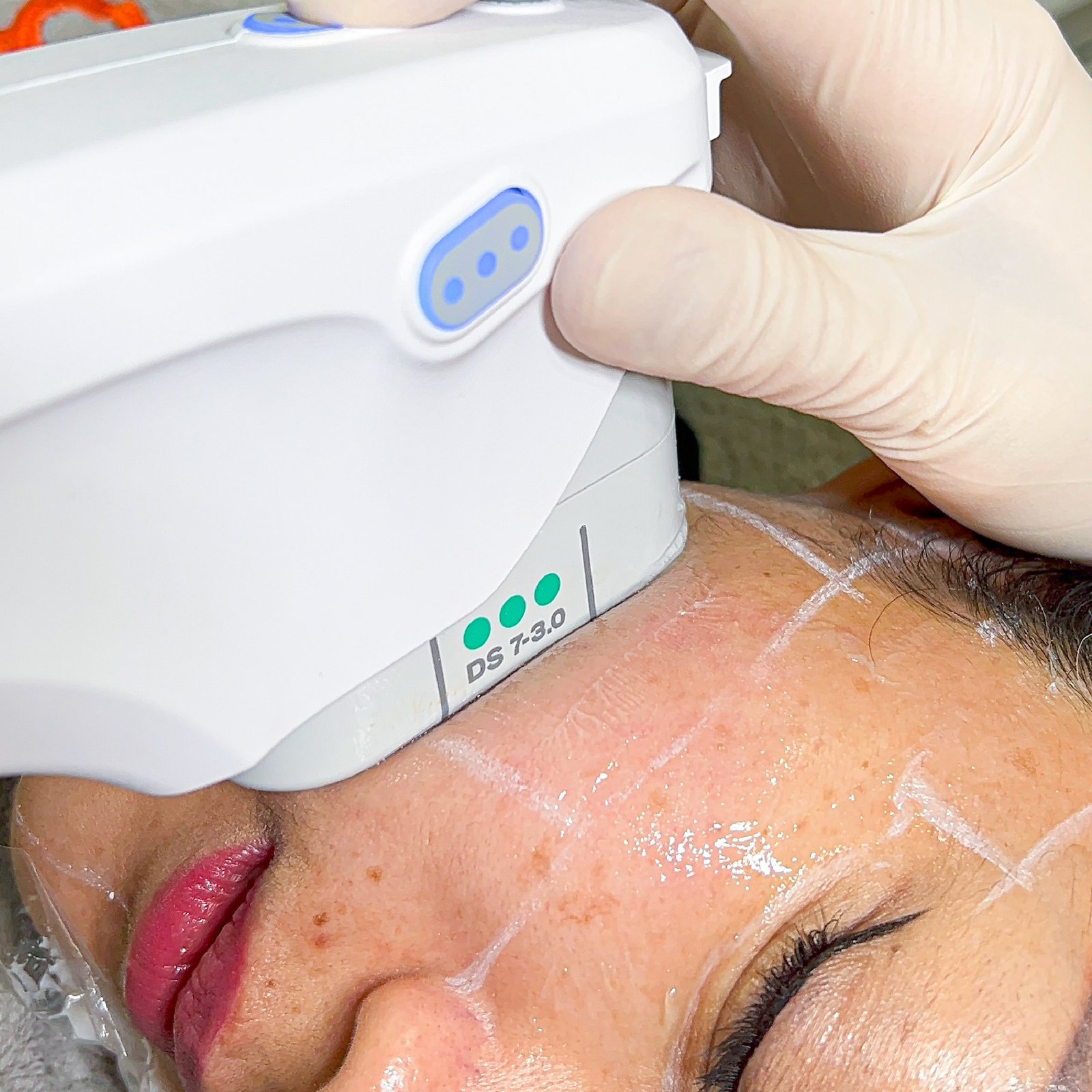 aset fikri ultherapy-12.jpg